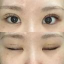 二重埋没 フローラクリニック DAY 3 サムネイル用