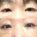 クマ治療 / 脂肪注入（肌） / ボトックス（あご） 銀座みゆき通り美容外科 大阪梅田院 DAY 14 サムネイル用