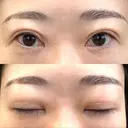 二重切開 / 上まぶたたるみ取り / PRP皮膚再生療法 BRIGHTS beauty clinic DAY 83 サムネイル用