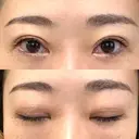 二重切開 / 上まぶたたるみ取り / PRP皮膚再生療法 BRIGHTS beauty clinic DAY 85 サムネイル用