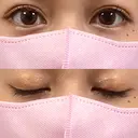 二重埋没 BELINDA CLINIC（ベリンダクリニック）新宿院 AFTER サムネイル用