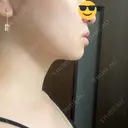 脂肪吸引（顔） / ボトックス（エラ・小顔） ルラ美容クリニック 大阪本院 DAY 47 サムネイル用