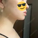 脂肪吸引（顔） / ボトックス（エラ・小顔） ルラ美容クリニック 大阪本院 DAY 47 サムネイル用