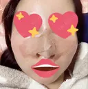 隆鼻術 / 軟骨移植 フェアクリニック川口 DAY 1 サムネイル用