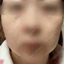 ヴェルヴェットスキン アリエル美容クリニック 大宮院 DAY 43 サムネイル用