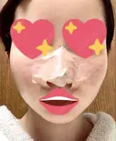 隆鼻術 / 軟骨移植 フェアクリニック川口 DAY 2 サムネイル用