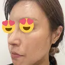 隆鼻術 / 鼻中隔延長（切開） / タレ目形成・グラマラスライン（切開） / 軟骨移植 / 脂肪注入（額） リッツ美容外科 東京院 DAY 9 サムネイル用
