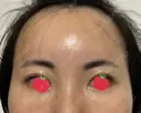 ヒアルロン酸注入（額） / ヒアルロン酸注入（こめかみ） ユウコ形成外科クリニック DAY 8 サムネイル用