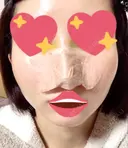 隆鼻術 / 軟骨移植 フェアクリニック川口 DAY 3 サムネイル用