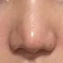 小鼻縮小（切開） GLANZ CLINIC DAY 29 サムネイル用