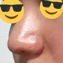 小鼻縮小（切開） GLANZ CLINIC DAY 29 サムネイル用
