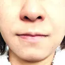 PRP皮膚再生療法 聖心美容クリニック 札幌院 DAY 13 サムネイル用