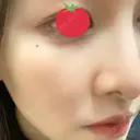 アートメイク（ほくろ） oneUPclinic AFTER サムネイル用