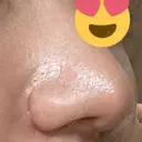 小鼻縮小（切開） GLANZ CLINIC DAY 30 サムネイル用