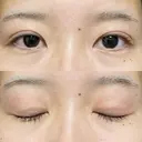 二重埋没 / 自然癒着法 シンデレラ＆ダヴィンチクリニック DAY 563 サムネイル用
