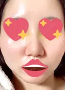 隆鼻術 / 軟骨移植 フェアクリニック川口 DAY 6 サムネイル用