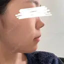 糸リフト / バッカルファット除去 / 脂肪吸引（顔） / ヒアルロン酸注入（あご） / ボトックス（エラ・小顔） アリエル美容クリニック 大宮院 DAY 130 サムネイル用