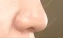 小鼻縮小（切開） 山本クリニック DAY 9 サムネイル用