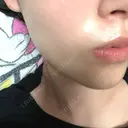 その他（輪郭） / ボトックス（エラ・小顔） TCB東京中央美容外科 堺院 DAY 3 サムネイル用
