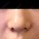 小鼻縮小（切開） 山本クリニック DAY 5 サムネイル用