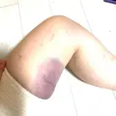 クマ治療 / ヒアルロン酸注入（額） あじまビューティークリニック DAY 0 サムネイル用