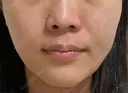 小鼻縮小（非切開） AI Beauty Clinic （エーアイ美容クリニック） DAY 4 サムネイル用