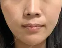 小鼻縮小（非切開） AI Beauty Clinic （エーアイ美容クリニック） DAY 5 サムネイル用