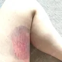 クマ治療 / ヒアルロン酸注入（額） あじまビューティークリニック DAY 1 サムネイル用