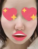 隆鼻術 / 軟骨移植 フェアクリニック川口 DAY 10 サムネイル用