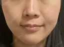 小鼻縮小（非切開） AI Beauty Clinic （エーアイ美容クリニック） DAY 6 サムネイル用