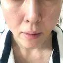 糸リフト ノーチェビューティクリニック DAY 7 サムネイル用
