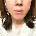 糸リフト ノーチェビューティクリニック DAY 8 サムネイル用