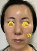 ヒアルロン酸注入（額） / ヒアルロン酸注入（こめかみ） ユウコ形成外科クリニック DAY 17 サムネイル用