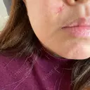 ほくろ・いぼ切除（肌） LIKI CLINIC KOBE AFTER サムネイル用