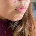 ほくろ・いぼ切除（肌） LIKI CLINIC KOBE DAY 3 サムネイル用