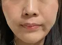 小鼻縮小（非切開） AI Beauty Clinic （エーアイ美容クリニック） DAY 9 サムネイル用