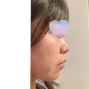 鼻尖形成（切開） Olino美容外科・美容皮膚科 AFTER サムネイル用