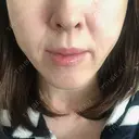 糸リフト ノーチェビューティクリニック DAY 11 サムネイル用