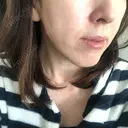 糸リフト ノーチェビューティクリニック DAY 11 サムネイル用