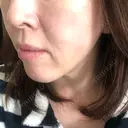 糸リフト ノーチェビューティクリニック DAY 11 サムネイル用