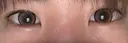 ヒアルロン酸注入（涙袋） TCB東京中央美容外科 長野院 AFTER サムネイル用