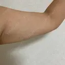 脂肪溶解注射（二の腕） 石倉クリニック 水戸院 DAY 14 サムネイル用