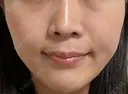 小鼻縮小（非切開） AI Beauty Clinic （エーアイ美容クリニック） DAY 10 サムネイル用