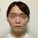 糸リフト / バッカルファット除去 / 脂肪吸引（顔） / ボトックス（あご） / ヒアルロン酸注入（あご） / ボトックス（エラ・小顔） / ヒアルロン酸注入（唇） / その他（口元） アリエル美容クリニック 大宮院 DAY 61 サムネイル用
