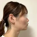 糸リフト / バッカルファット除去 / 脂肪吸引（顔） / ボトックス（あご） / ヒアルロン酸注入（あご） / ボトックス（エラ・小顔） / ヒアルロン酸注入（唇） / その他（口元） アリエル美容クリニック 大宮院 DAY 61 サムネイル用