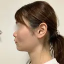 糸リフト / バッカルファット除去 / 脂肪吸引（顔） / ボトックス（あご） / ヒアルロン酸注入（あご） / ボトックス（エラ・小顔） / ヒアルロン酸注入（唇） / その他（口元） アリエル美容クリニック 大宮院 DAY 61 サムネイル用