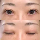 二重切開 / 上まぶたたるみ取り / PRP皮膚再生療法 BRIGHTS beauty clinic DAY 101 サムネイル用