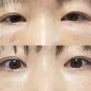 クマ治療 / 脂肪注入（肌） / ボトックス（あご） 銀座みゆき通り美容外科 大阪梅田院 DAY 32 サムネイル用