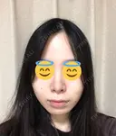 鼻尖形成（切開） / 軟骨移植 JUN CLINIC DAY 14 サムネイル用