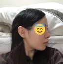 鼻尖形成（切開） / 軟骨移植 JUN CLINIC DAY 14 サムネイル用